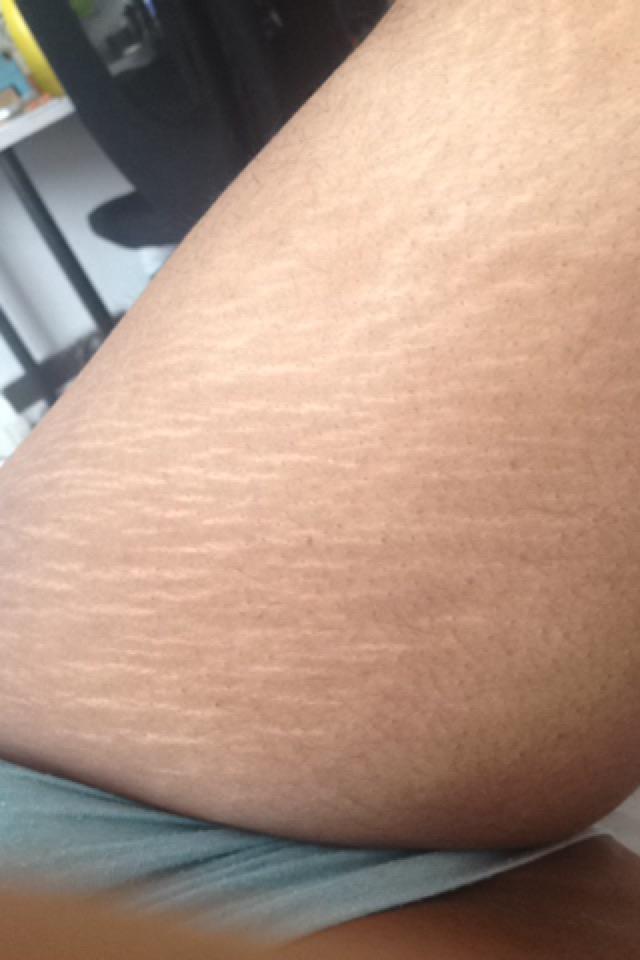 I'm so insecure about my stretch marks, I can't get naked in front of my boyfriend?