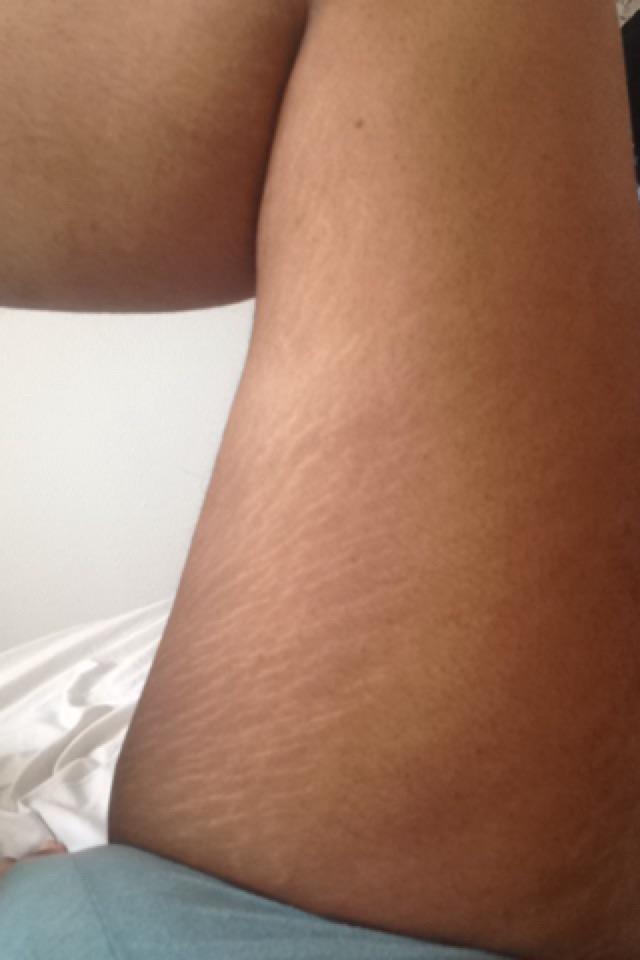 I'm so insecure about my stretch marks, I can't get naked in front of my boyfriend?