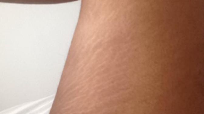 I'm so insecure about my stretch marks, I can't get naked in front of my boyfriend?