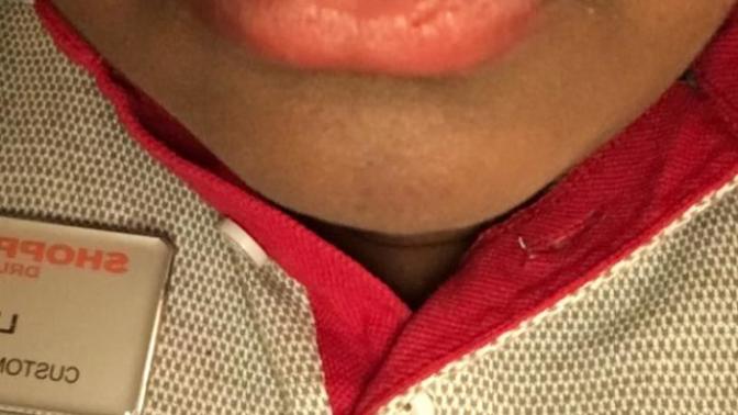 How to get rid of discoloration on upper lips?