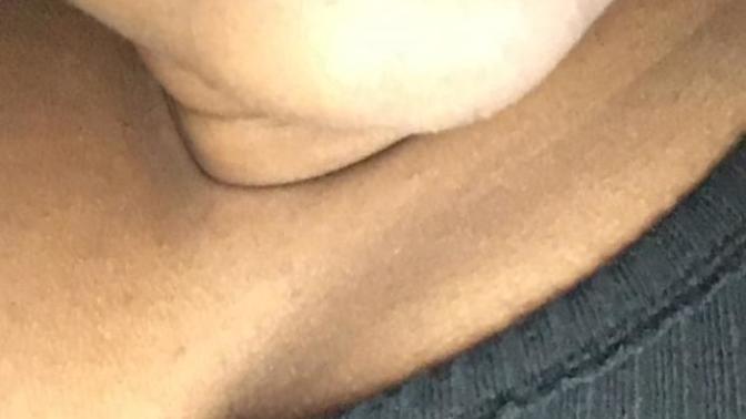 How to get rid of shadow above upper lip?