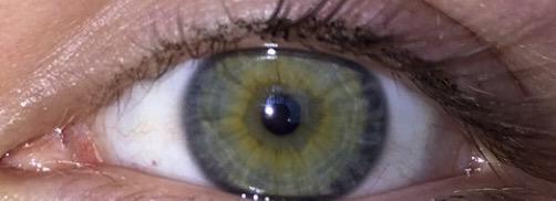 Do I have heterochromia?