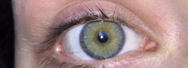 Do I have heterochromia?