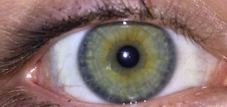 Do I have heterochromia??