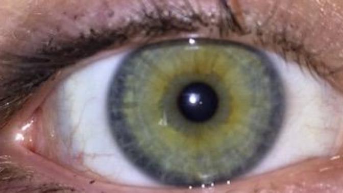 Do I have heterochromia?
