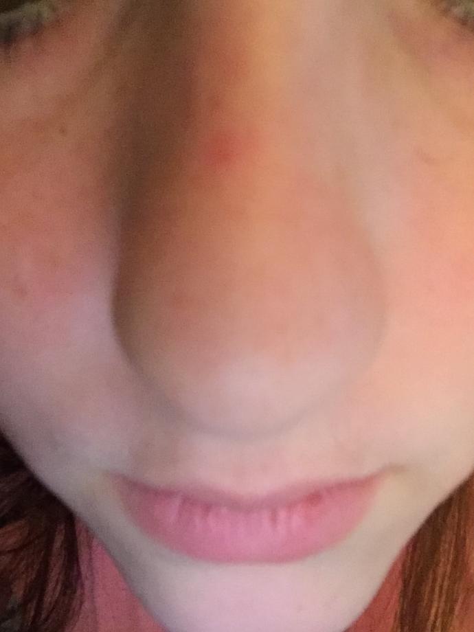 What is this hideous dot on my nose and how do I get rid of it?