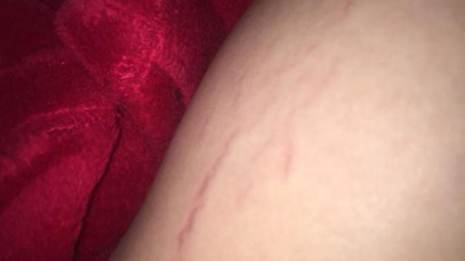 Stretch marks or varicose veins?