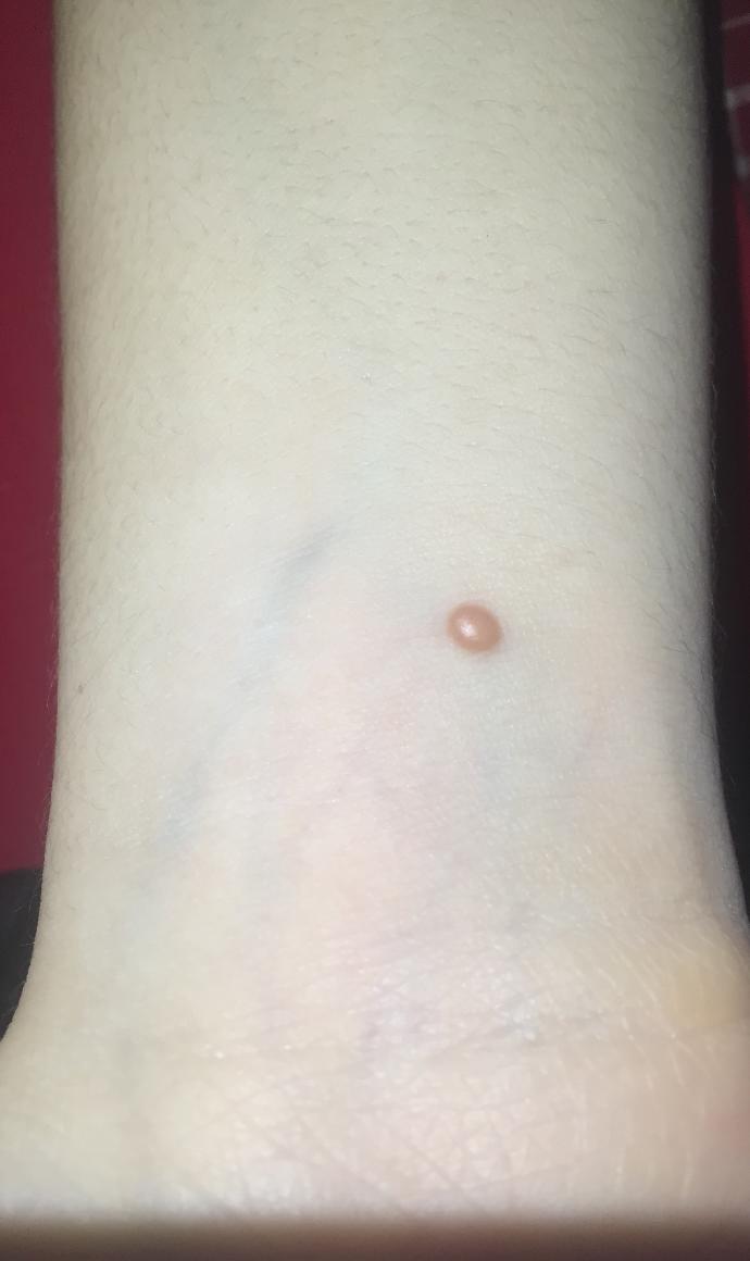 My brother has this (picture included) on his hand, do you know what it is?