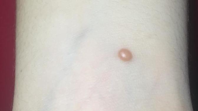 My brother has this (picture included) on his hand, do you know what it is?