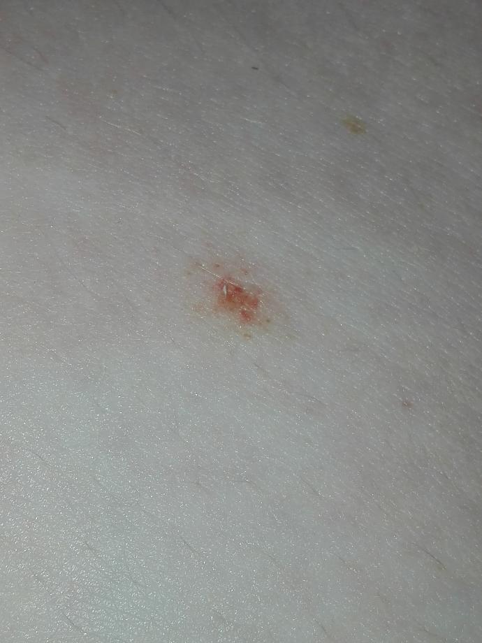 Strange red mark on stomach/hip?