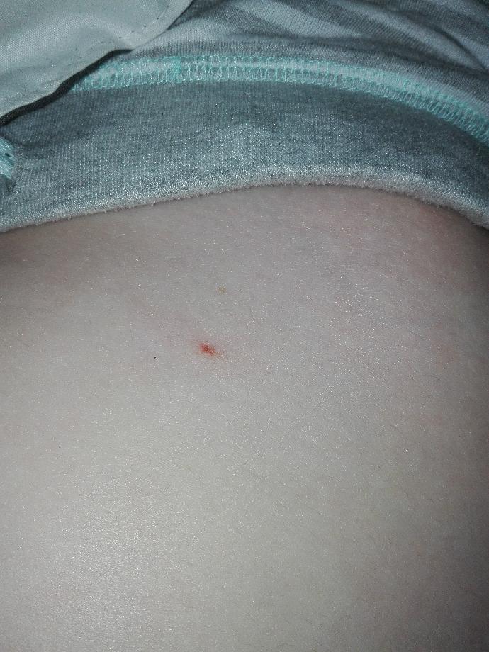 Strange red mark on stomach/hip?