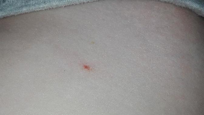 Strange red mark on stomach/hip?
