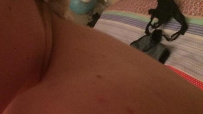 Is my back acne gross and should I hide or it's okay to be visible?