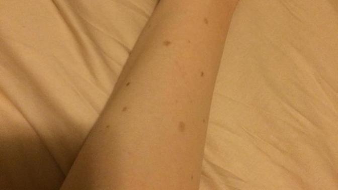 Guys, do you find moles unattractive?