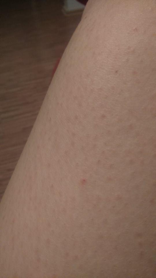 Why is my leg skin like that?