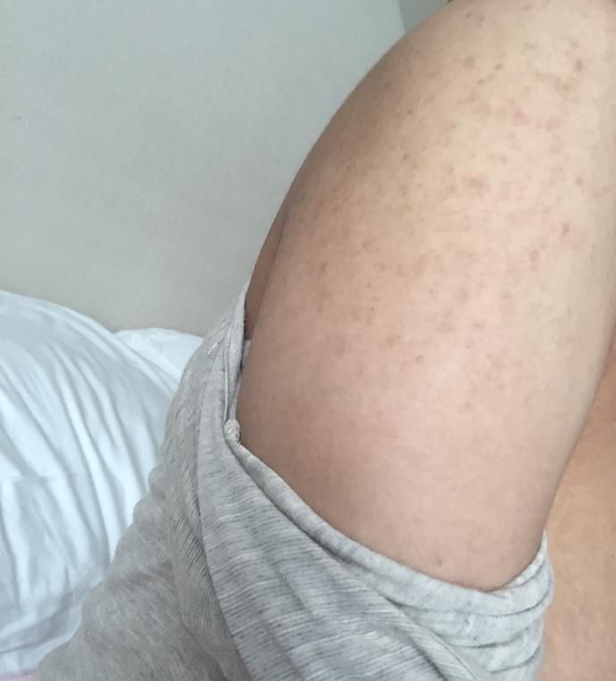 Is this acne on my shoulders, chest? Pic?
