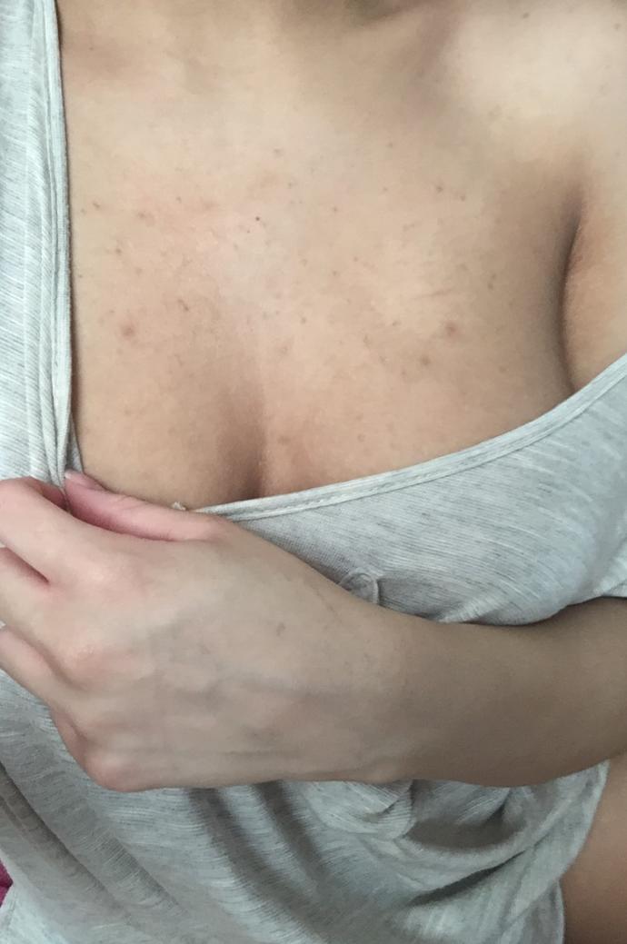 Is this acne on my shoulders, chest ? Pic?