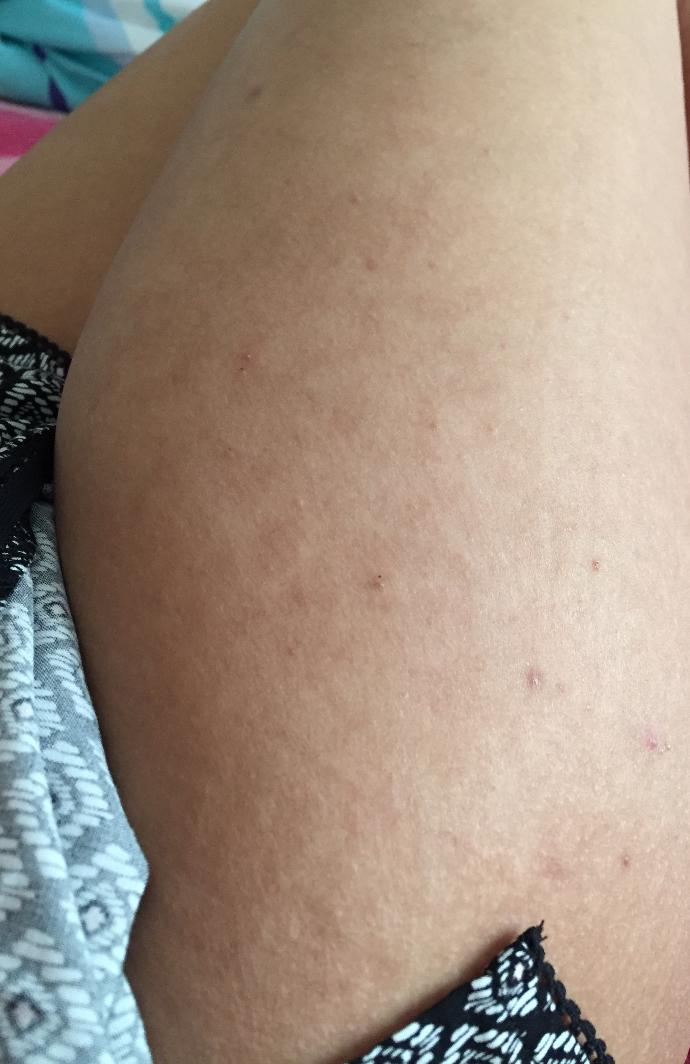 Is this acne on my shoulders, chest? Pic?