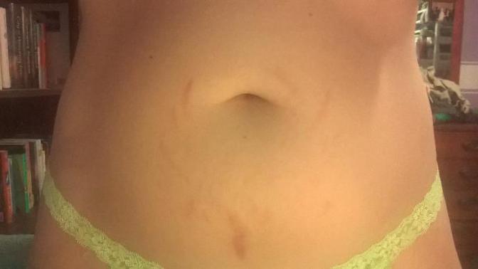 Are these stretch marks a turn off?