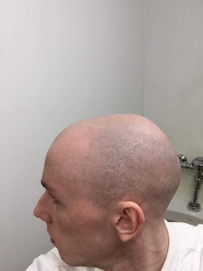 Would girls date a guy your age who shaved his head bald from hair loss? Or is bald a turn off to you so young?