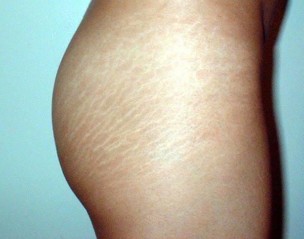 Guys, what do you think of cellulite lines? A turn off?