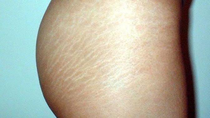 Guys, what do you think of cellulite lines? A turn off?