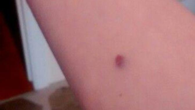 I got a TB test for work is that bruise supposed to go away?
