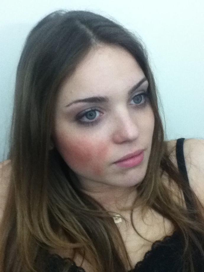 How do you hide face bruises? Please this is important?