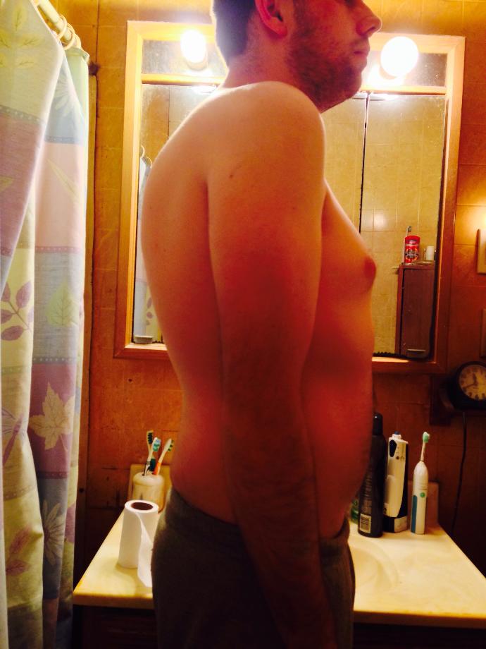 Is there anything I do about my posture? Can I use a posture brace to fix it? I have scoliosis if that matters?