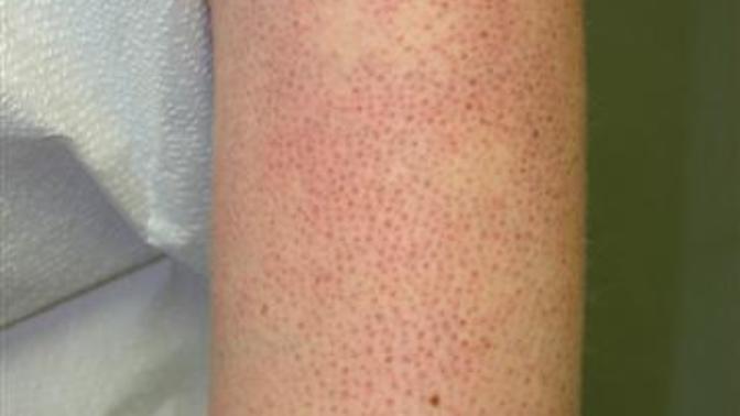 Do you have chicken skin on your arms?