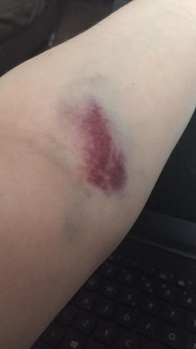 I had a blood test but my arm is left badly bruised... Is this normal?