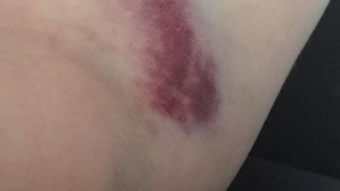 I had a blood test but my arm is left badly bruised... Is this normal?