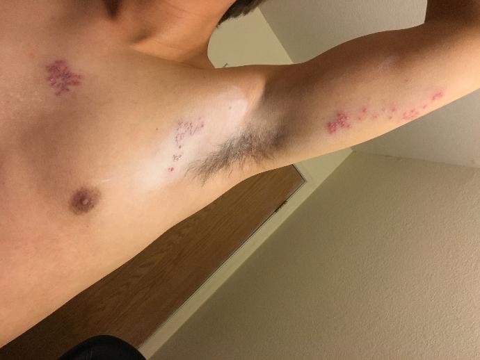 (Warning!! Pics)  Blistering, Burning, Painful Rashes forming on Upper body?<br />