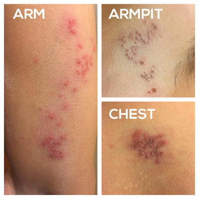 (Warning!! Pics) Blistering, Burning, Painful Rashes forming on Upper body?