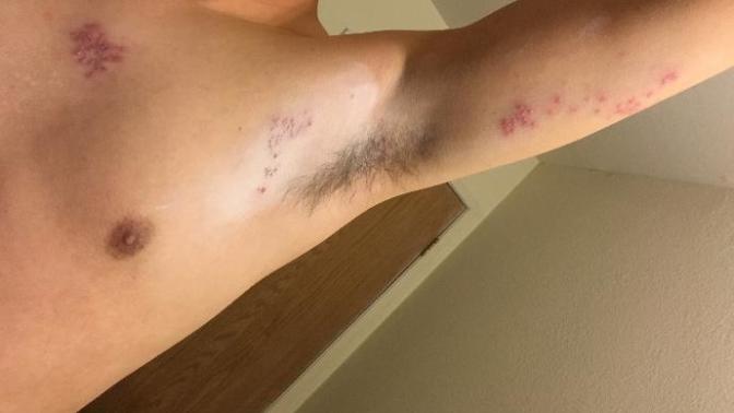 (Warning!! Pics) Blistering, Burning, Painful Rashes forming on Upper body?
