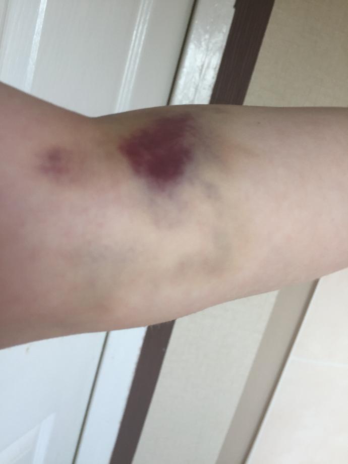 (Update) Does the bruising around my arm after a blood test look serious?