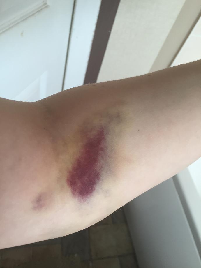 (Update) Does the bruising around my arm after a blood test look serious?