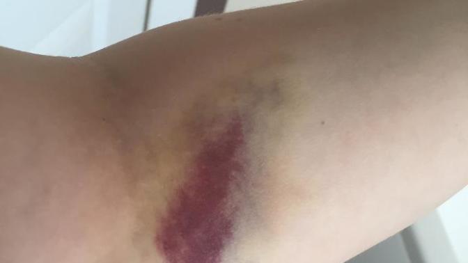 (Update) Does the bruising around my arm after a blood test look serious?