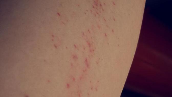Help... I have a rash?