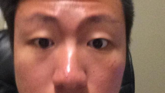 Does acne play a huge tole in looks? Am I ugly?