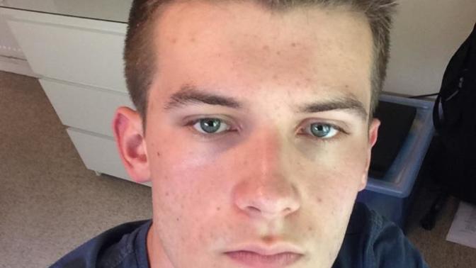 Is my acne scarring noticeable, and how long until it goes away?