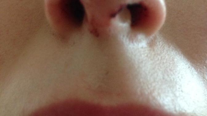 Uneven nostrils after hump removal surgery? Why?