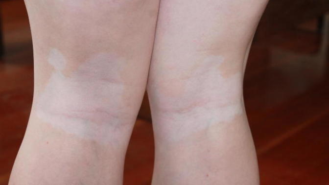 Leucoderma/vitiligo on fair skin, bad looking or ok?