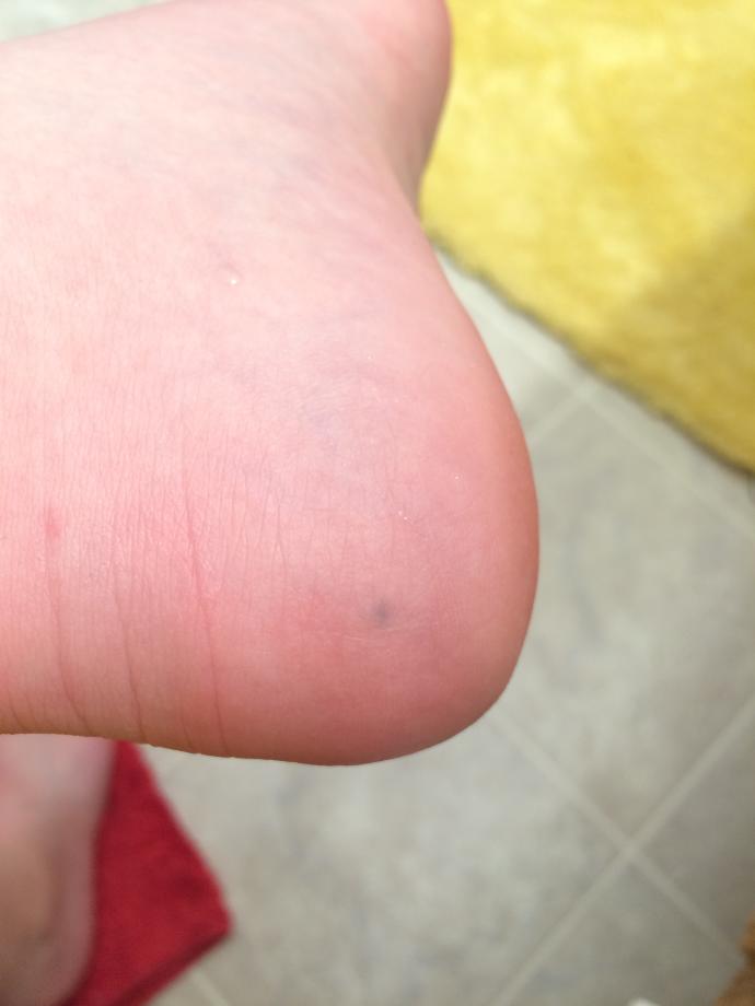 I have lead in my foot?