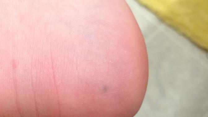I have lead in my foot?