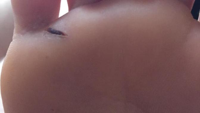 Accidentally stepped on an exacto knife a few days ago and now bruising is showing up on the other side of where I stepped on it?