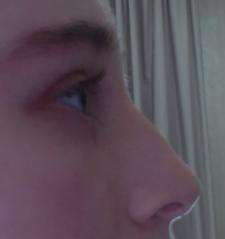 Why is there still a bump on my nose after rhinoplasty?