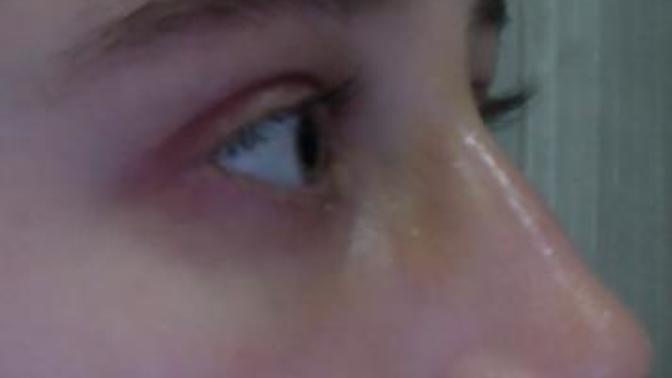 Why is there still a bump on my nose after rhinoplasty?