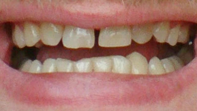 Should I get braces again and get my teeth fixed?