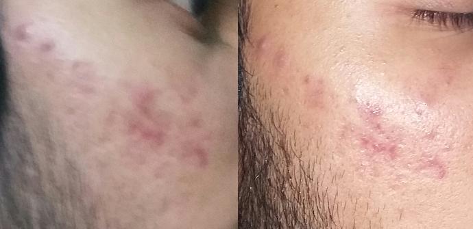 How to remove red spots from my face?